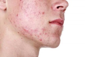 acne en onzuivere huid